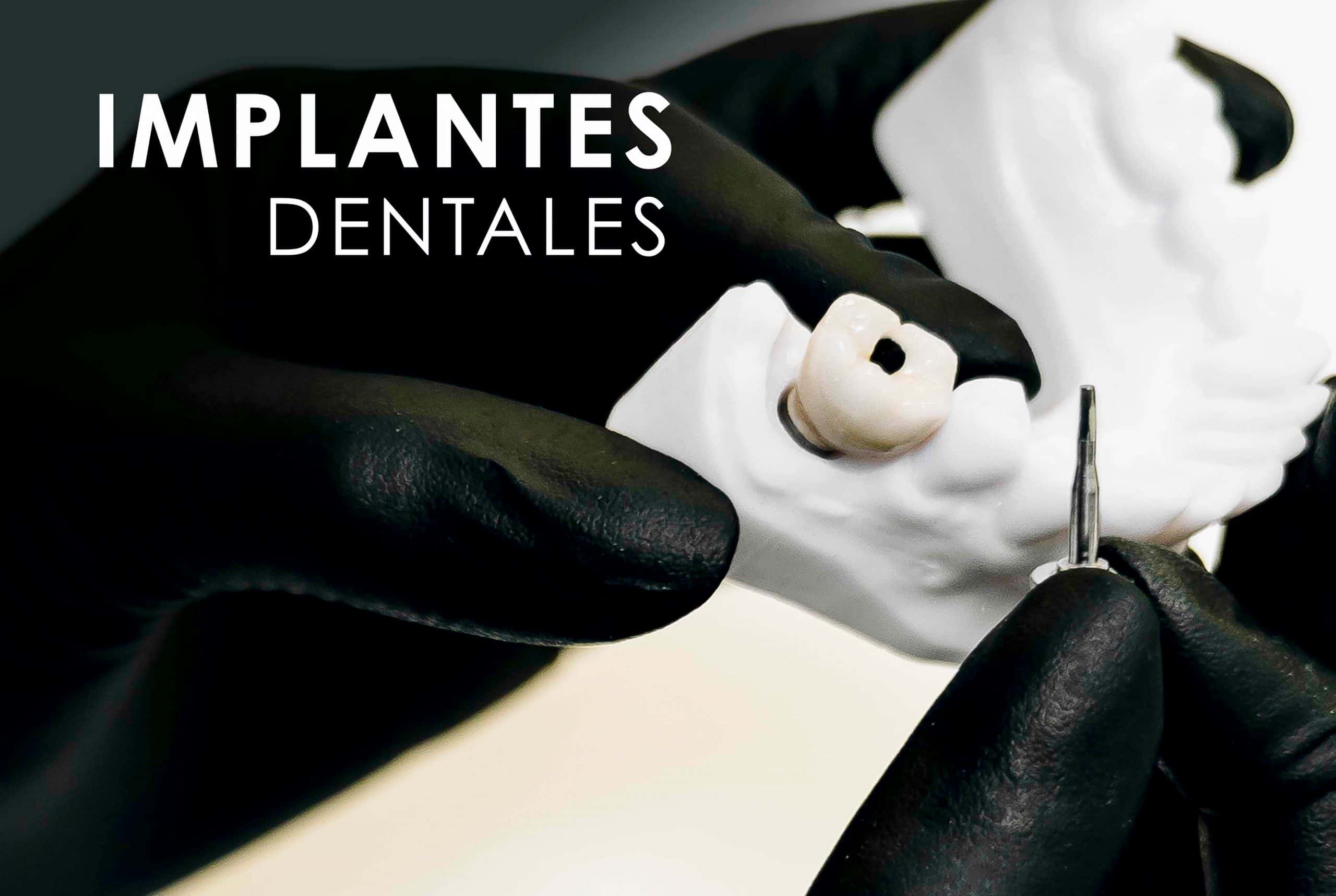 Implantes Dentales Clínica Dental Bernabeu