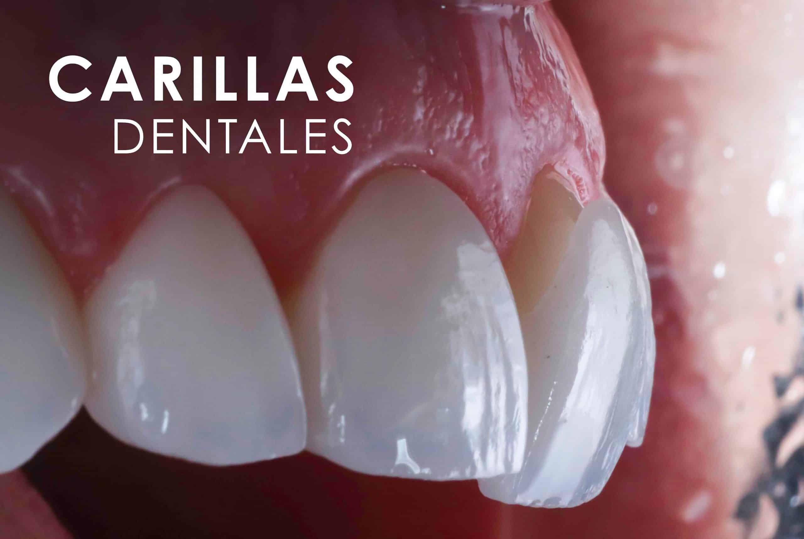 Carillas Dentales Clínica Dental Bernabeu