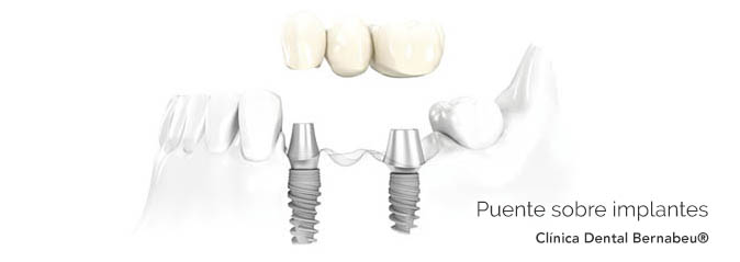 Prótesis dental puente