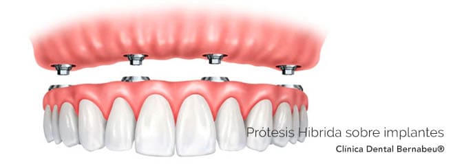 Prótesis dental Hibrida