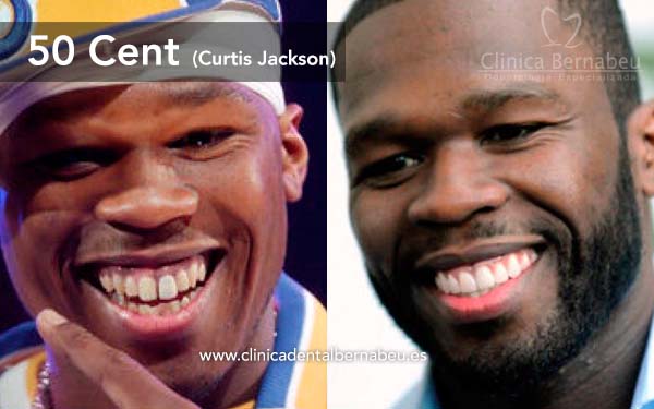 dientes famosos 50cent