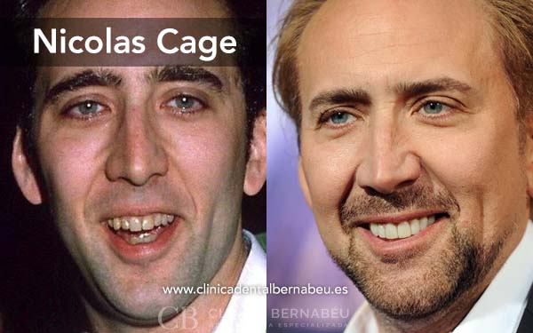 Dientes nicolas cage