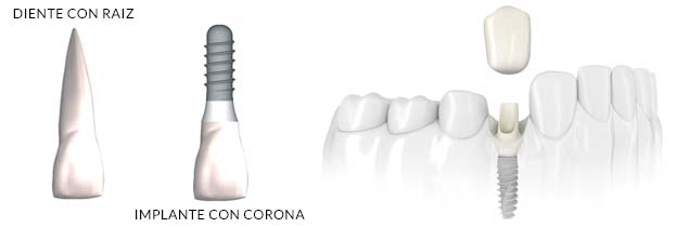 Implantología dental de carga inmediata 