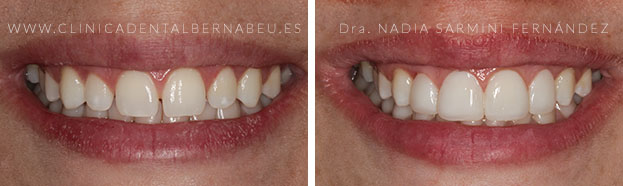 carilla dental composite