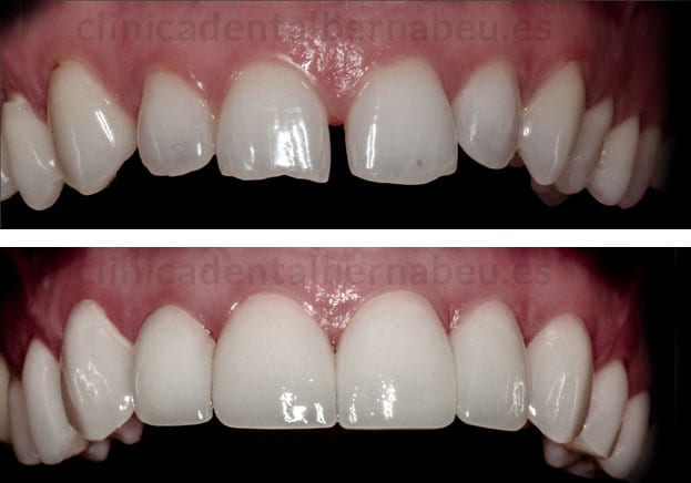 tipos de carillas de porcelana