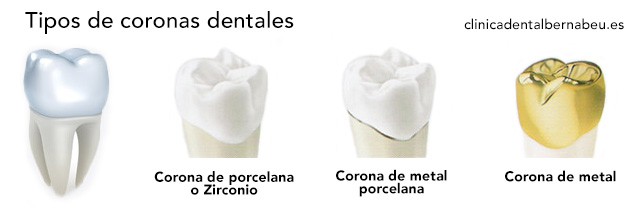 tipos de fundas coronas en madrid