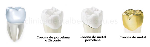 Coronas de Zirconio