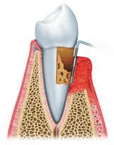 curetaje dental en madrid