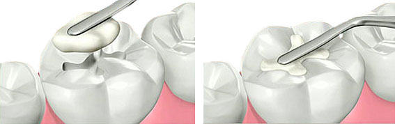 empaste dental composite Madrid