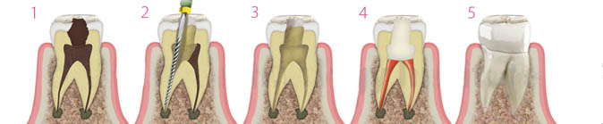 endodoncia tratamiento en madrid