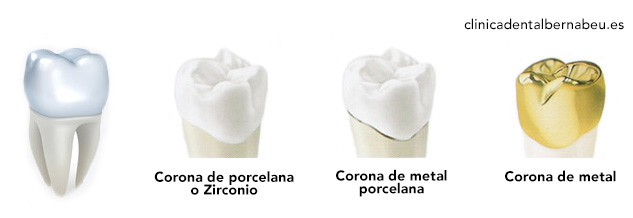 tipos de fundas dentales