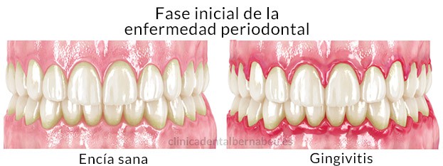 Diferencias entre la periodontitis y gingivitis