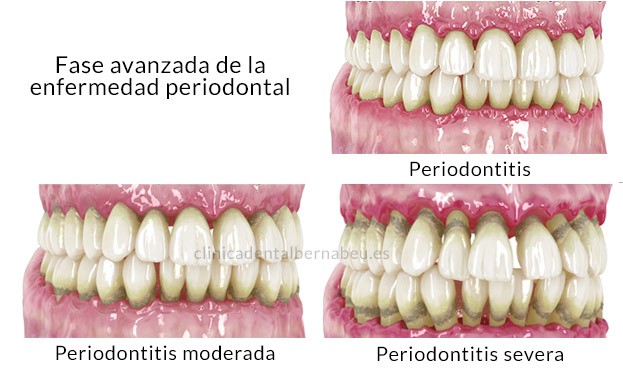 periodontitis diferencias gingivitis