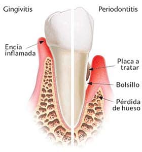 Sintomas de la Gingivitis