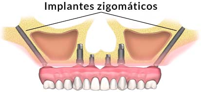 implante sin hueso zigomatico