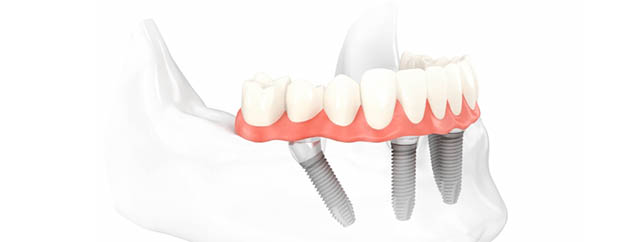 implantología dental carga inmediata