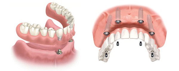 La dentadura postiza