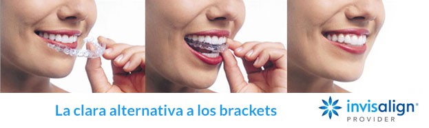 tipos de brackets invisalign