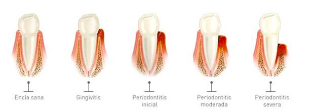 gingivitis periodontitis piorrea