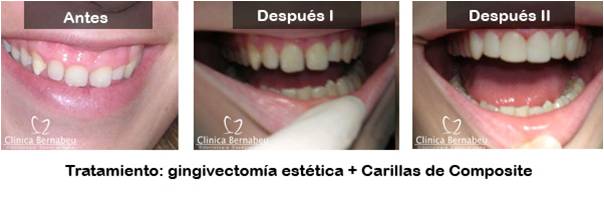 Periodoncia estetica de encías