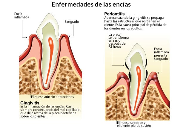 periodontitis