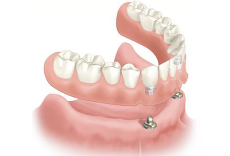 Protesis dental sobre implantes