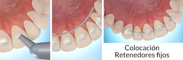 retenedores de ortodoncia fijos