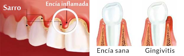 tratamiento de gingivitis