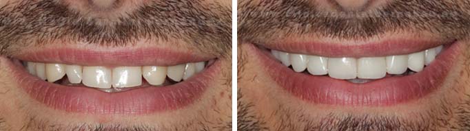 Carillas lightveneers